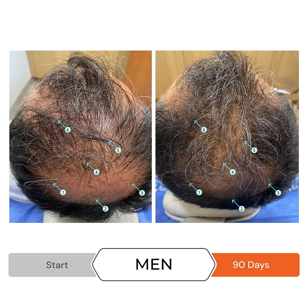 Revita Shampoo w/Biotin, Caffeine and Hair Growth Stimulating Ingredients, Helps Block  w/- Nanoxidil 5% Hair Regrowth Treatment