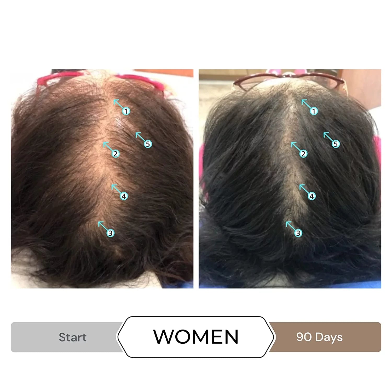 Revita Shampoo w/Biotin, Caffeine and Hair Growth Stimulating Ingredients, Helps Block  w/- Nanoxidil 5% Hair Regrowth Treatment