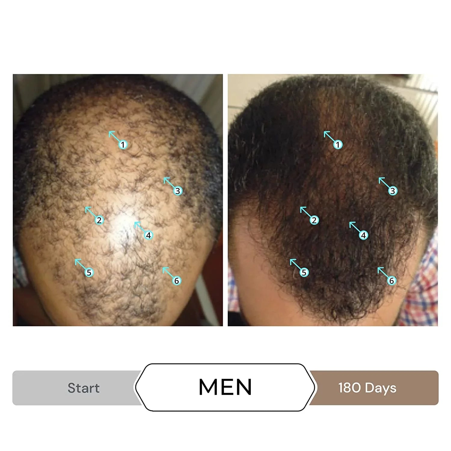 Revita Shampoo w/Biotin, Caffeine and Hair Growth Stimulating Ingredients, Helps Block  w/- Nanoxidil 5% Hair Regrowth Treatment